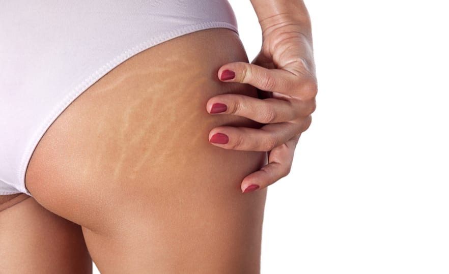 Stretch Marks and How To Prevent Them At Define Clinic in Beaconsfield