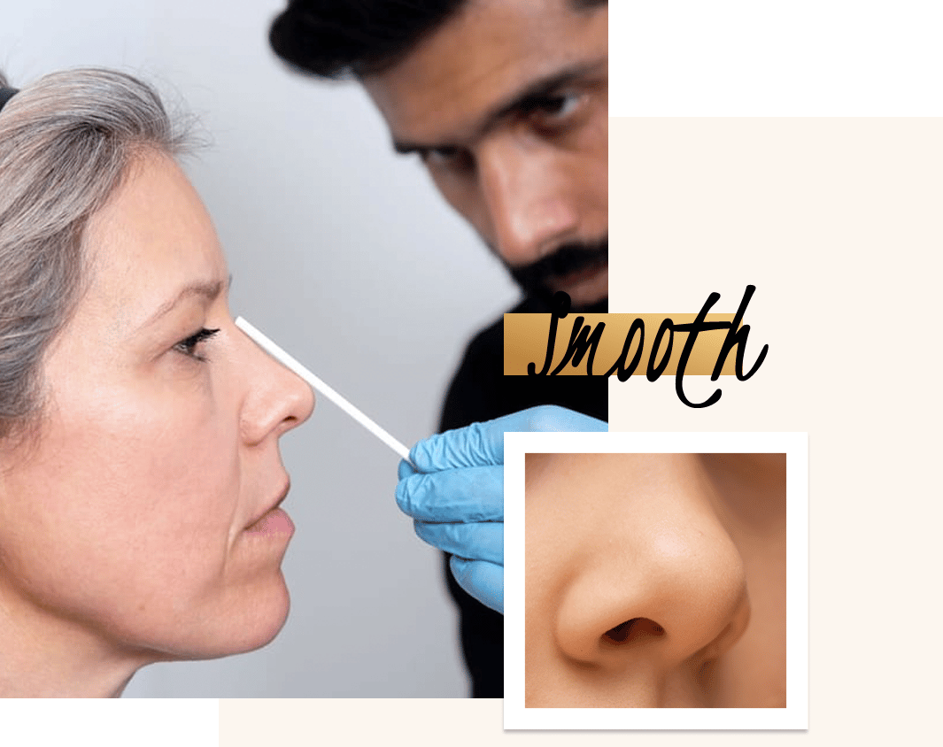 Droopy nose? At Define Clinic we use dermal fillers as part of non-surgical rhinoplasty treatment or even Anti-Wrinkle Injections to stop the muscles pulling down the nose.