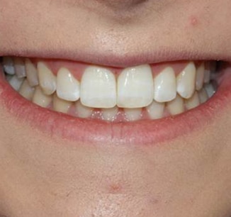 After Invisalign braces at Define Clinic Beaconsfield